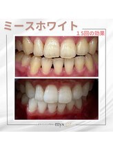 ミースホワイトニング(mys whitening)/ビフォーアフター【歯科提携】