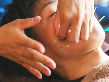 うみそら 千種院の写真/鍼初心者さんにもお勧め！効果をしっかり実感できる本格美容鍼をエリアトップクラスの低価格で受けられる！
