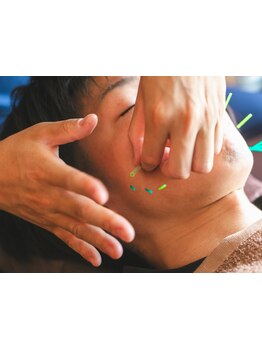 鍼灸施術を受けたい