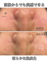 アトワ(A toi)/ハーブピーリング（棘あり）