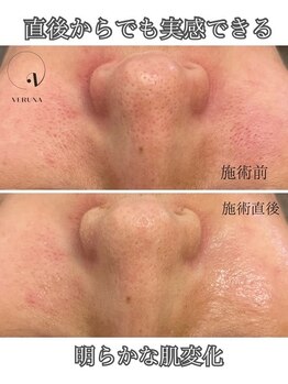 アトワ(A toi)/ハーブピーリング(棘あり)