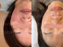 ハナワクシングプラス 高知(HanaWaxing+)/【肌質改善オーダメイド】