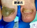 変形・肥厚した爪を正常な爪へ