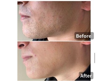 エアリアル 大川店/ヒゲ脱毛