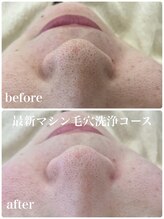 カラン(CALIN)/最新マシン毛穴洗浄コース