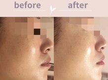 アール(R)/肌荒れにお悩みの方！