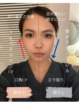 リム(Rim.)/美容鍼の効果