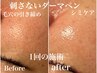 平日限定！肌質改善プラズマニア<毛穴/シミ/しわケア/ニキビ>