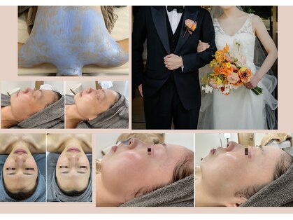 フォセット(fossette)の写真