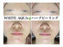 ホワイトアクア 加古川店(WHITE AQUA)/ハーブピーリング/毛穴/加古川