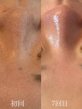 イルー(ILuu)/お客様ビフォーアフター