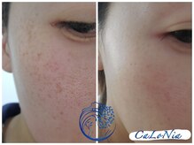 カロニア(CaLoNia)/小さな頑固なシミに働きかける