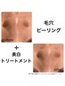 美肌人気No.1【ワンランク上の美白毛穴ピーリング】即→お肌にツヤとハリ♪