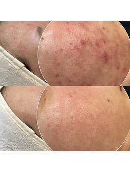 パリスヒロトン(PARIS HIROTON)/オプティル白玉