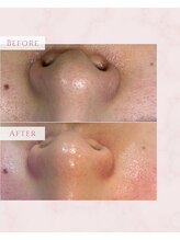 ジーンバイピエル 中野店(gene by PIEL)/#毛穴ケア#ピーリング#ワックス