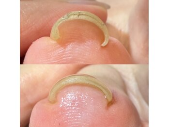 ロイヤル ビューティー サロン(Royal Beauty Saloon)/巻き爪ケア
