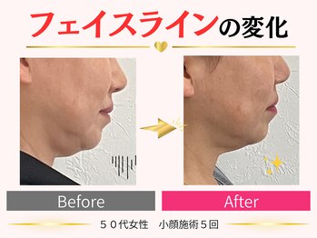 タイナ(taina)/50代女性/小顔施術5回