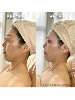 サロン ド ブラン アオヤマ(Salon de BLANC AOYAMA)/BIOPHYTO×韓国美容機器ソノケア