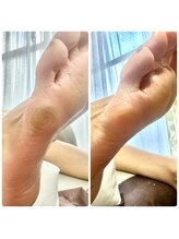 ボンド(The bond)/固く溜まった角質【フットケア】