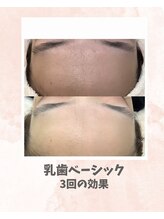 リンフェイス 浦安店(RINFACE)/頬の毛穴の開き、黒ずみにも◎