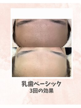リンフェイス 浦安店(RINFACE)/頬の毛穴の開き、黒ずみにも◎