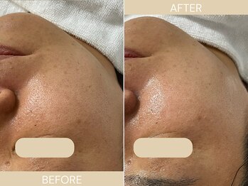 エクラ(eclat)/施術回数:1回