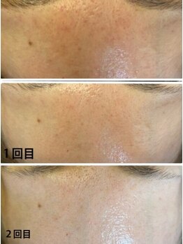 エスボーテ(sbeaute)/第5世代ピーリングダクトピール