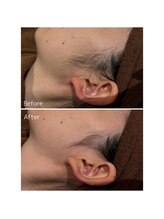 オアシスサカエ(OASIS SAKAE)/【もみあげ脱毛】（sパーツ）