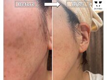 ルミラポー(Lumira Peau)/40代8回