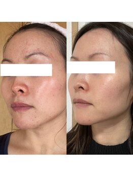 小顔エステsakura belle(サクラベル)/HARi入りハーブピーリング効果