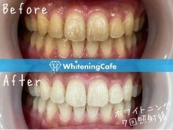 ホワイトニングカフェ赤羽店/ホワイトニングビフォーアフター