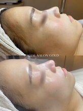 ゴールド 恵比寿店(GOLD)/毛穴洗浄とスキンケアの相乗効果