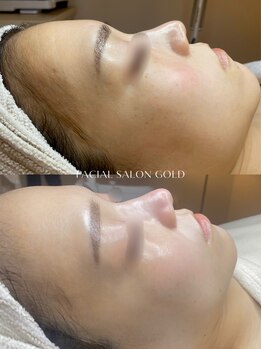 ゴールド 恵比寿店(GOLD)/毛穴洗浄とスキンケアの相乗効果