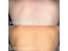 エピジュ(Epijyu)/女性の背中脱毛