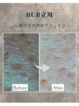 BUB 立川/毛穴の黒ずみ、くすみオフ