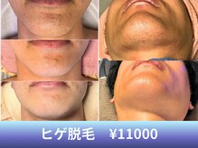 スミス(smith)の雰囲気（別人級！印象180度変わるヒゲ脱毛は5回でツルツル！）