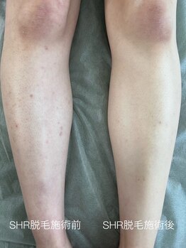 トリップ(trip)/脱毛だけじゃない!