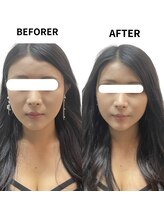 リノア 堀江(Linoa)/小顔矯正施術前後写真