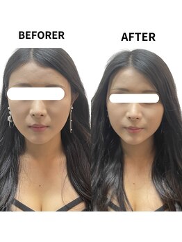 リノア 堀江(Linoa)/小顔矯正施術前後写真