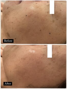 ミラ(Mila)/BeforeAfter☆