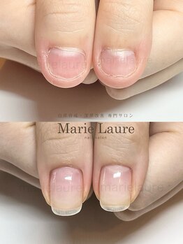 マリーロール 梅田店(Marie Laure)/自爪育成/深爪矯正/ネイルケア
