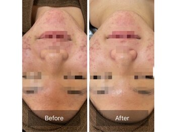 ルナート(Lunart)/ハーブピーリング【顔】