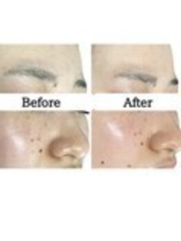 ル ボヌール 伊那店(le bonheur)/エクソソームハーブ1回の結果♪