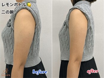 アモーラ(Amora)/レモンボトル二の腕
