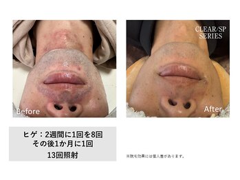 ザ エッセンシャル 碧南(THE Essential)/にきび・カミソリ負けケア