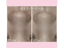 エステティック　レイビス 渋谷店(RAYVIS)/白玉ピーリング【黒ずみ毛穴】