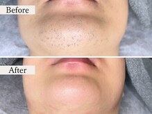 ルミナ(LUMINA)/顎髭