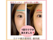 カナヤ鍼灸整骨院/美容鍼ビフォーアフター★