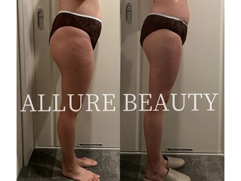 アリュールビューティー 下高井戸店(ALLURE BEAUTY)/90分15回モニター様