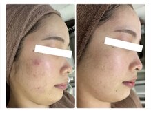 ホワイトアクア 浜松店(WHITE AQUA)/ハーブピーリング/ニキビケア